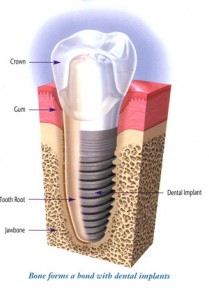Restauration d'une dent par implant dentaire